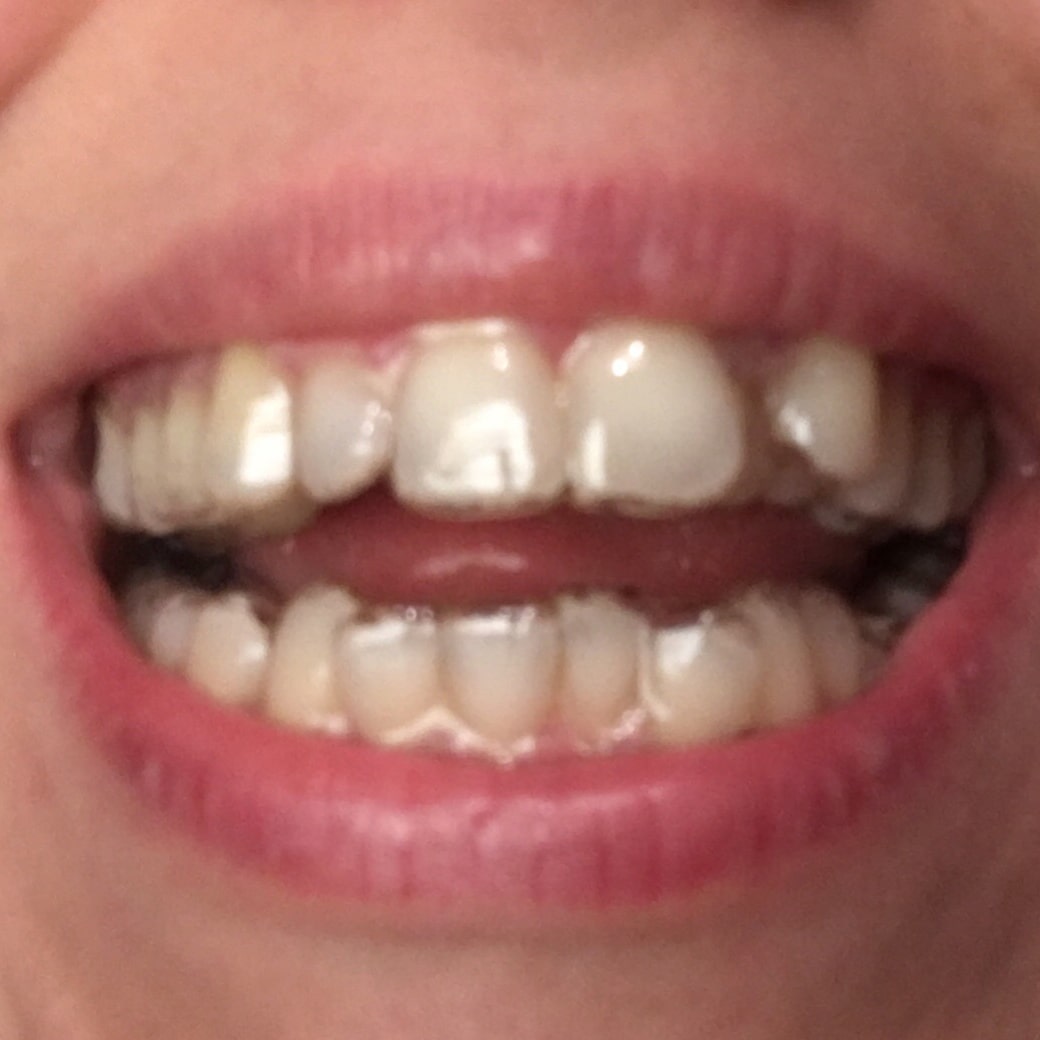 Retainers To Keep Teeth Straight After Braces Fixed or Removable?