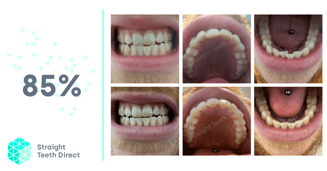 Online teeth straightening Ben's own Straight Teeth Direct™ journey