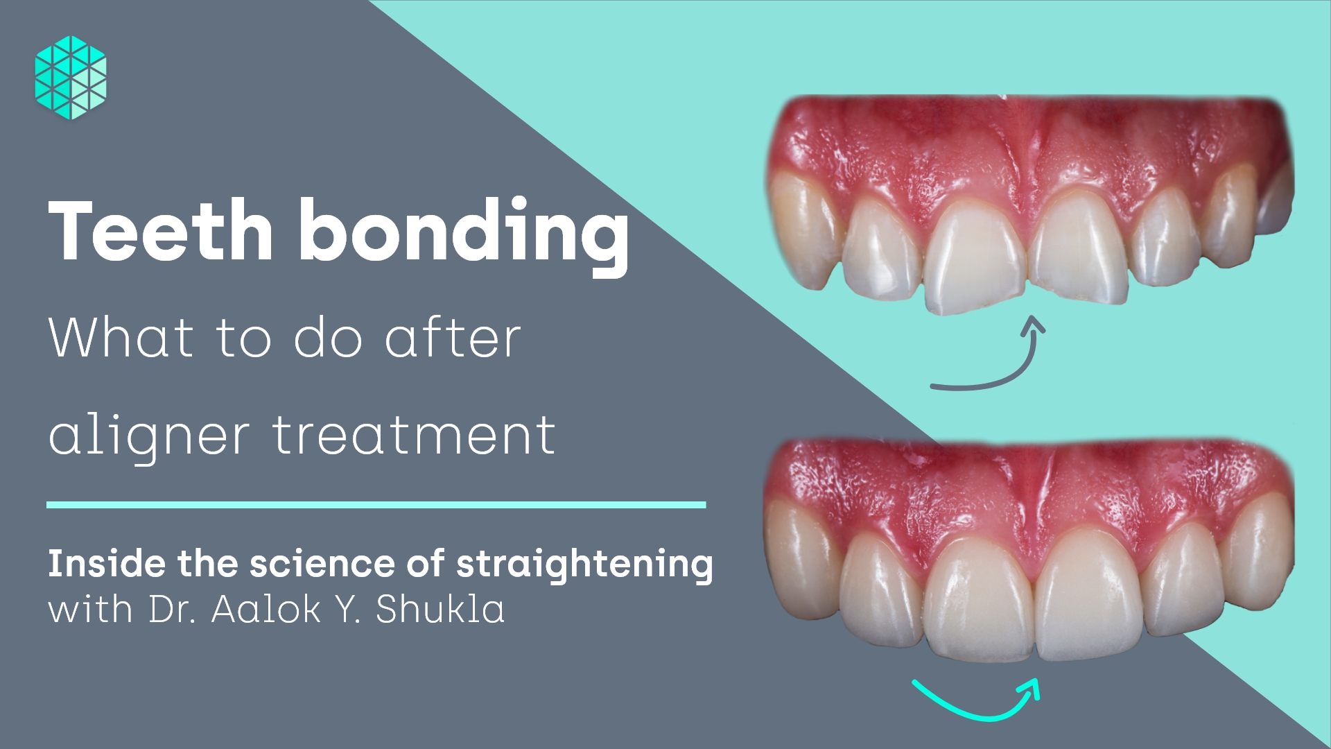 Is teeth bonding a good idea? What to do after aligner treatment