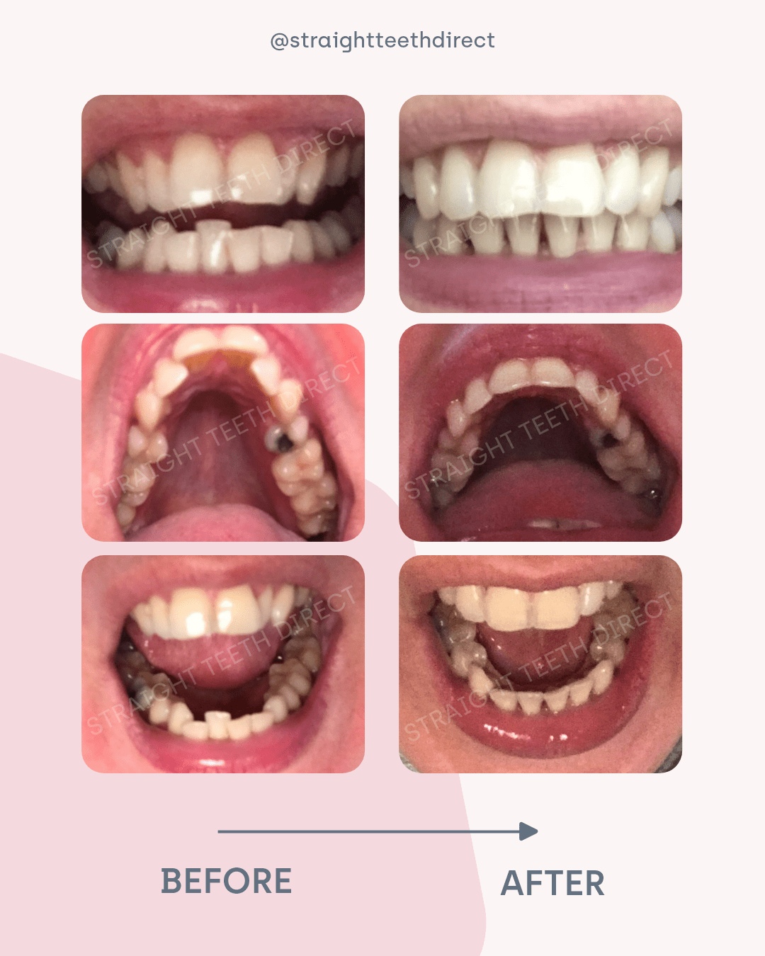 Affordable clear aligners that suit me! Michelle’s guest blog