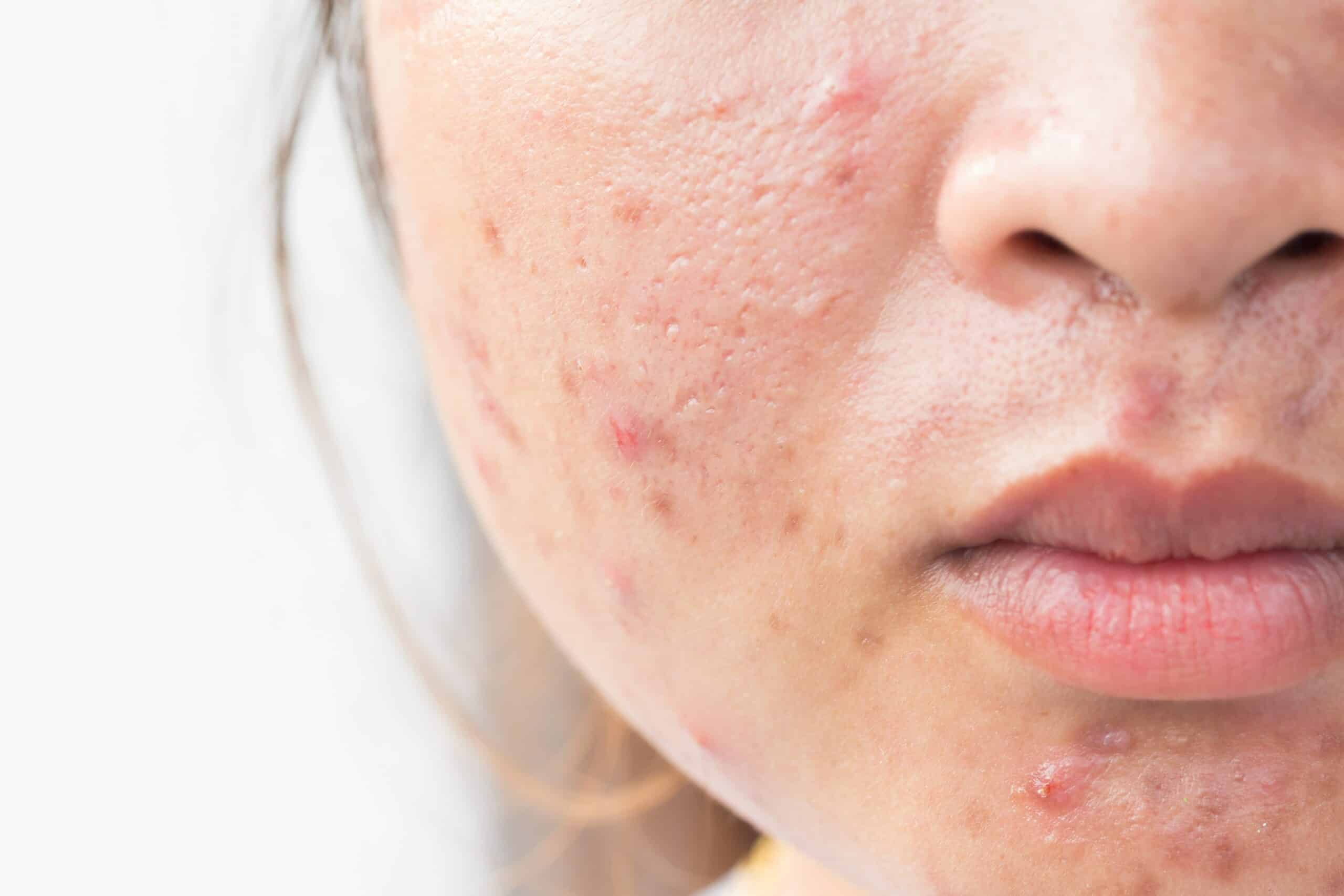 Natural acne scar treatment Can I get rid of acne scars naturally