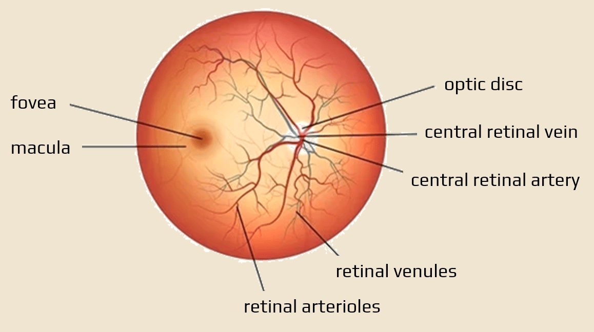 Papilledema STROKE MANUAL