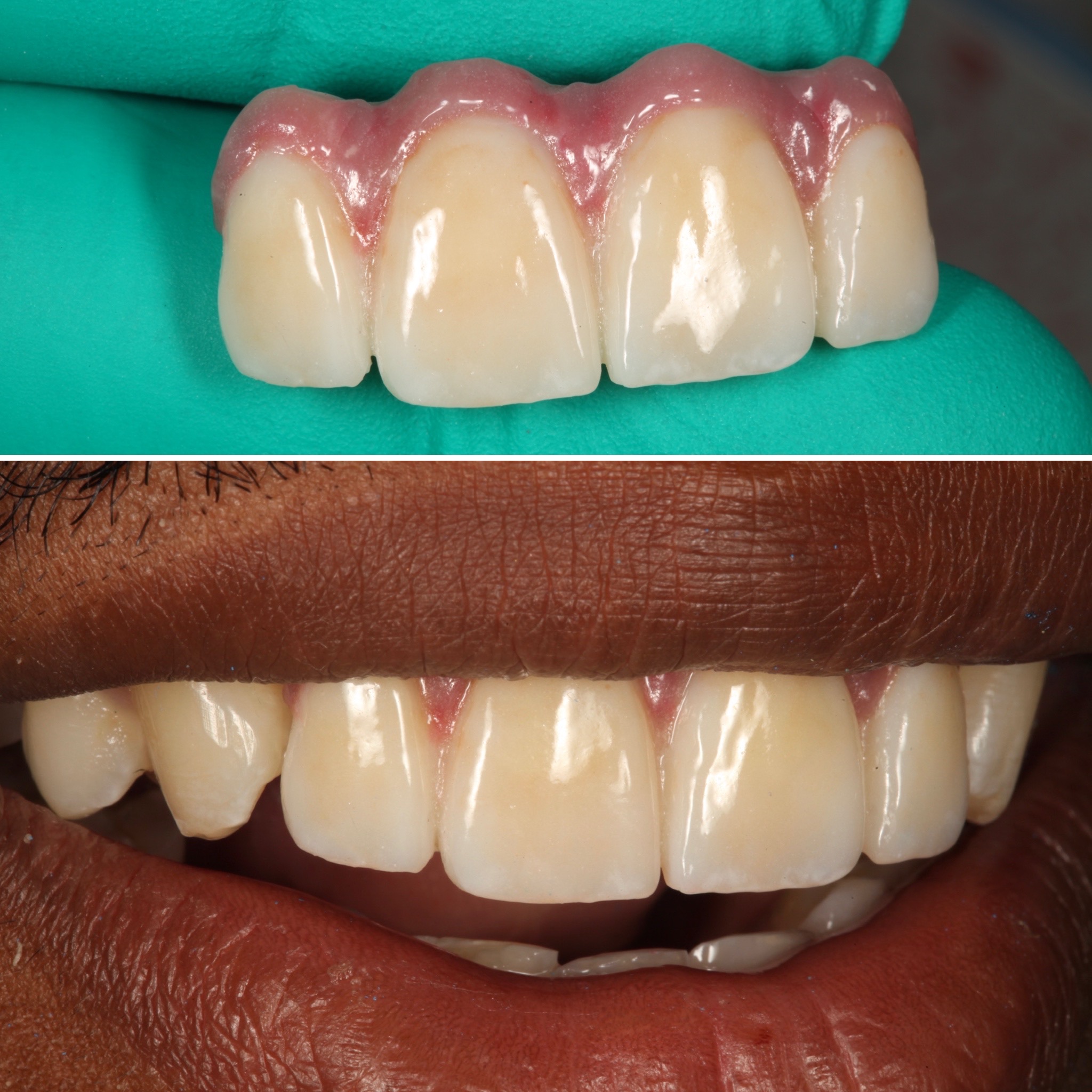 Implants Strupp & Brumm Cosmetic & Restorative Dentistry Clearwater FL