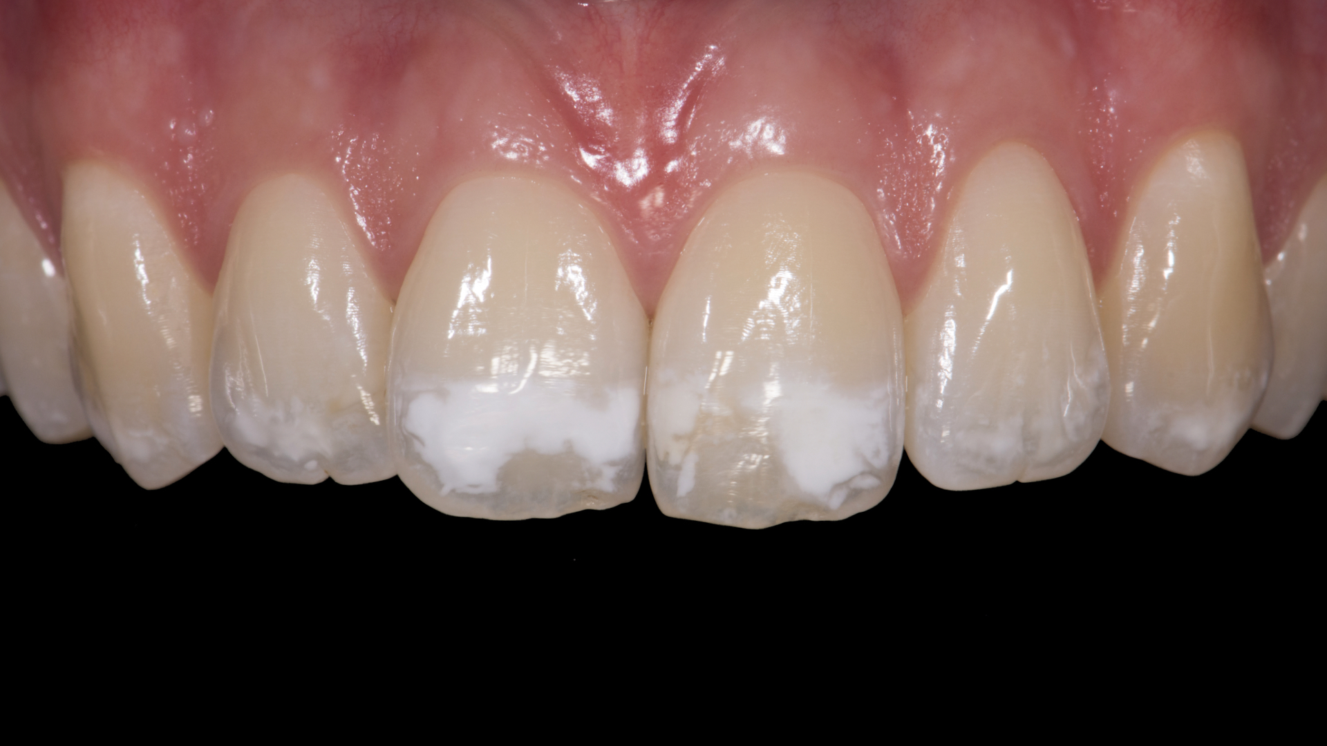 White spots removal and volume restitution