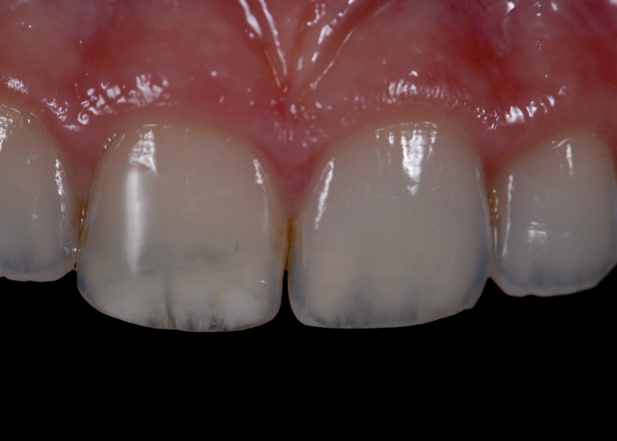 Composite build up protocols for complex class IV cavities with two