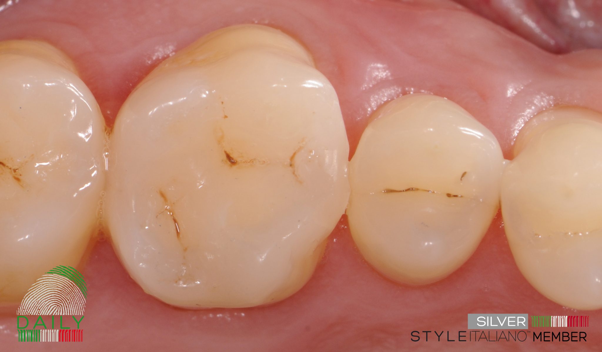 How Long Does It Take To Fill A Small Cavity Tooth Cavity Filling