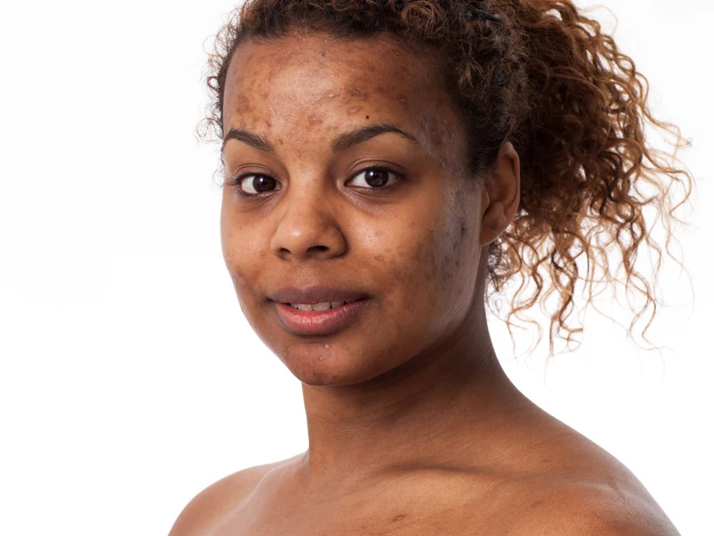 How To Remove Acne Scars: Creams, Lasers, And Realistic Results
