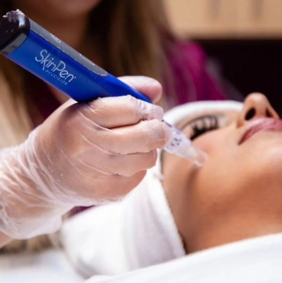 SkinPen MicroNeedling Suddenly Slimmer Med Spa