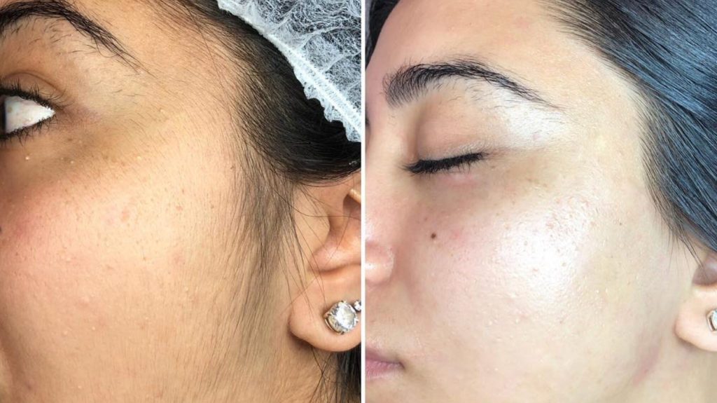 Dermaplaning Boston, MA Salem Dermaplaning