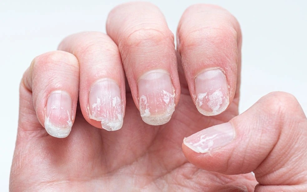 How to Get Rid of Peeling Nails Tips and Remedies for Healthy Nails(01)