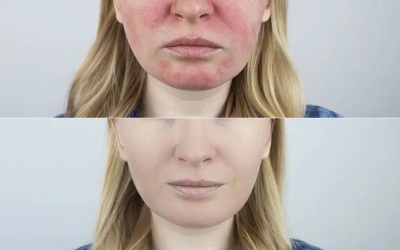 How to Get Rid of Redness on Face