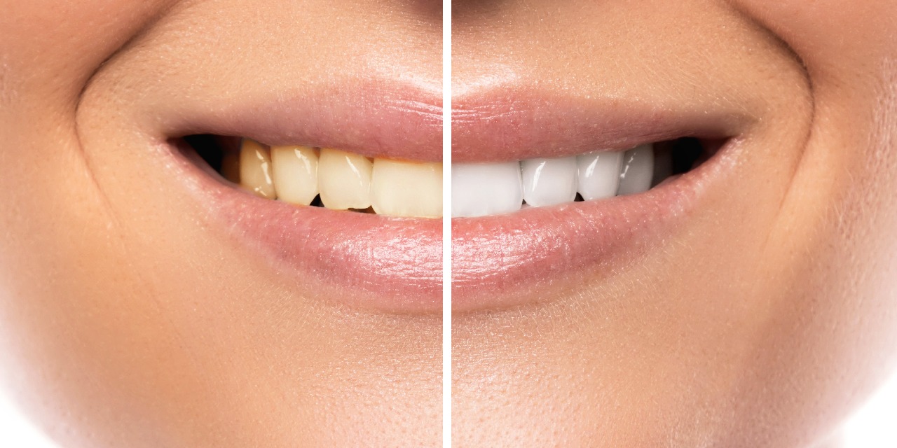 8 Easy Ways to Remove Tooth Stains Summirow Dental