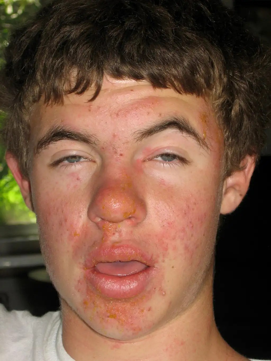 Poison Oak on face Photos, Diagrams & Topos SummitPost