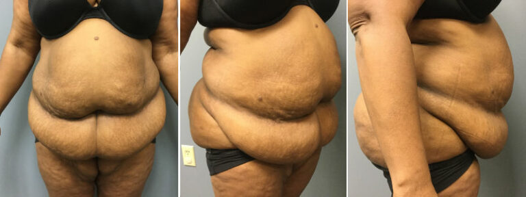 Tummy Tuck Summit Plastic Surgery
