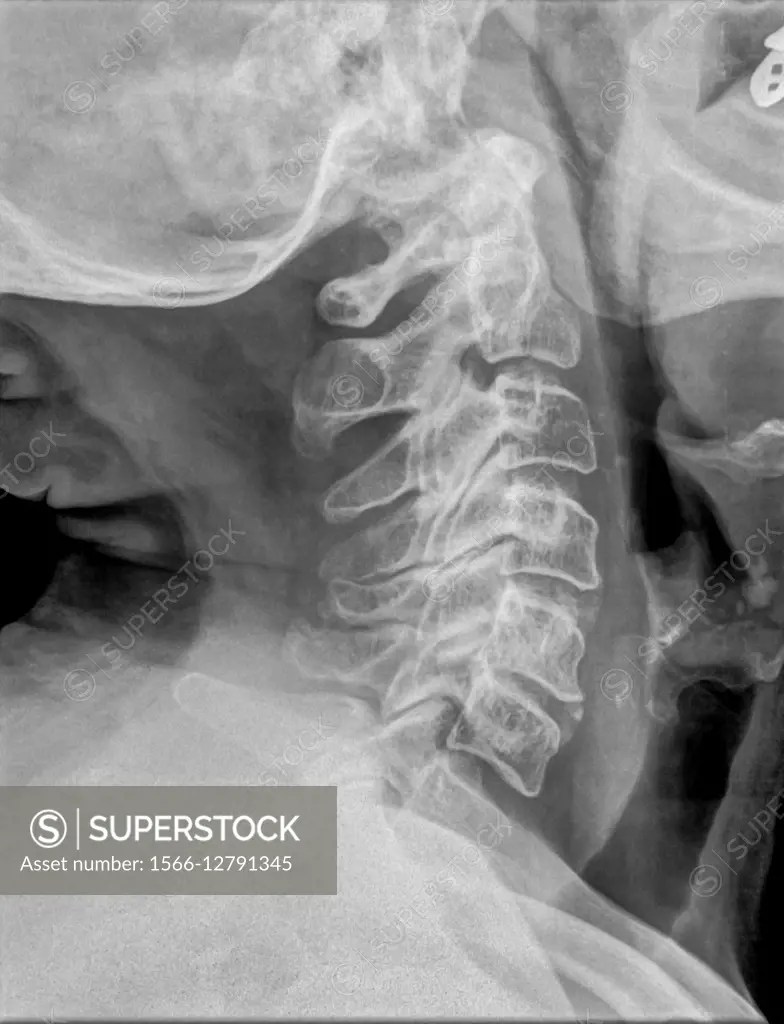 Normal Cervical spine xray of a 70 year old female patient side, view