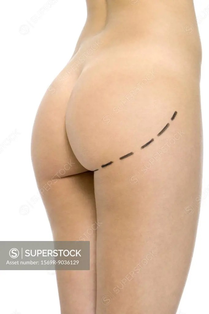 Nude woman with plastic surgery markings on buttocks, cropped view