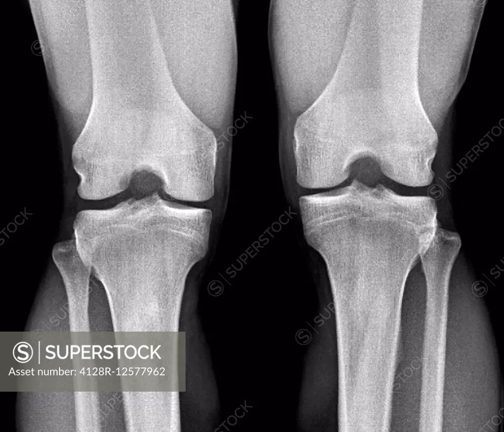 Normal knees. Frontal Xray of the healthy knees of a 28 year old