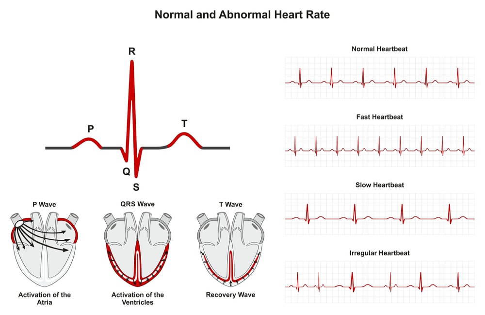 Irregular Heartbeat Sutton Place Dental Associates