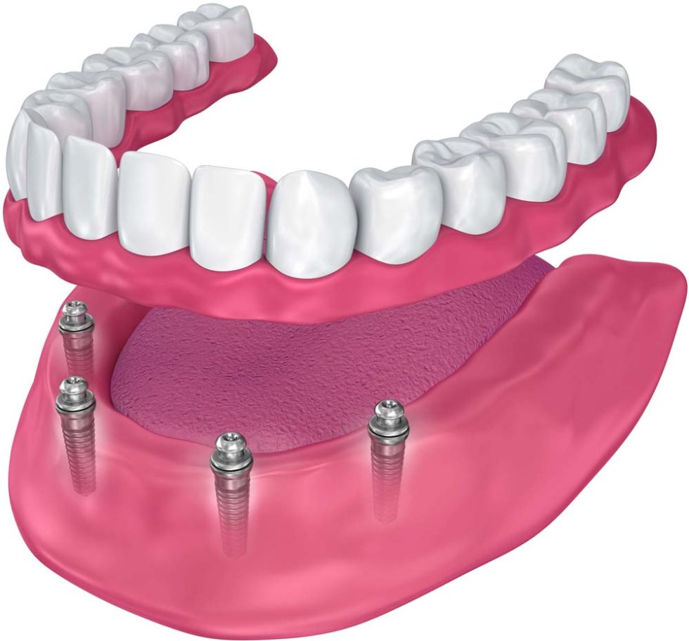 Best Midtown NYC Zoom Allon4 Dental Implants Near You Implant