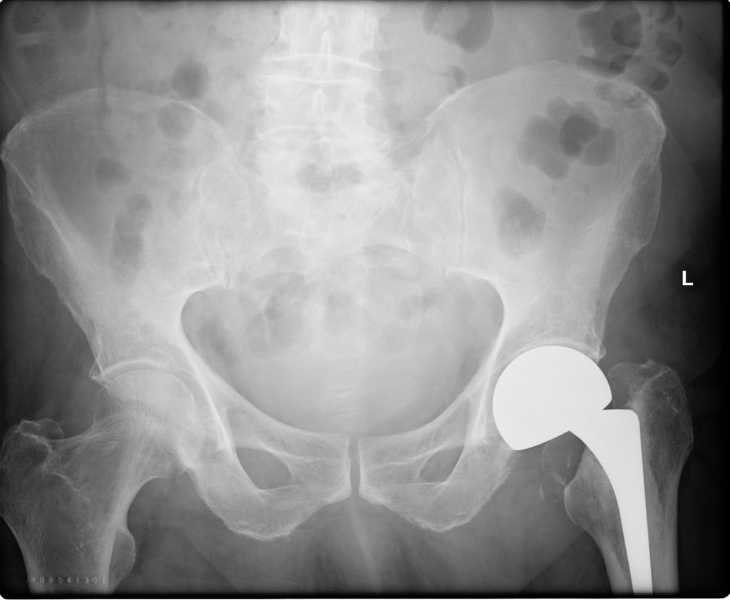 Hemiarthroplasty vs Total Hip Replacement Sutured