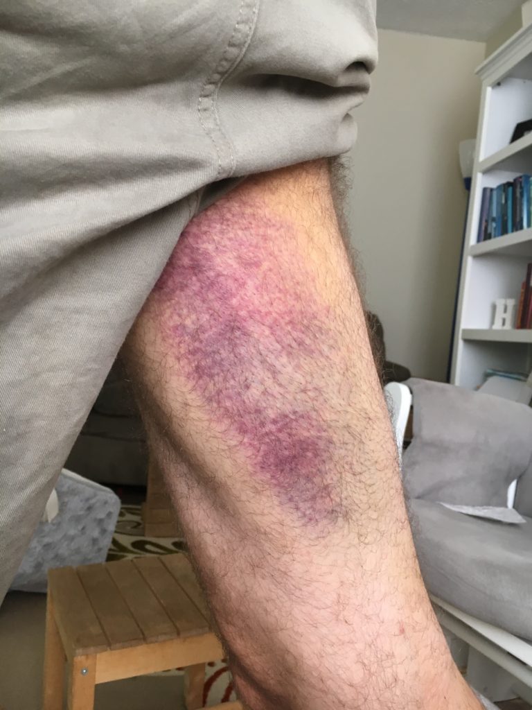 The Hamstring Injury The Glorious Mundane