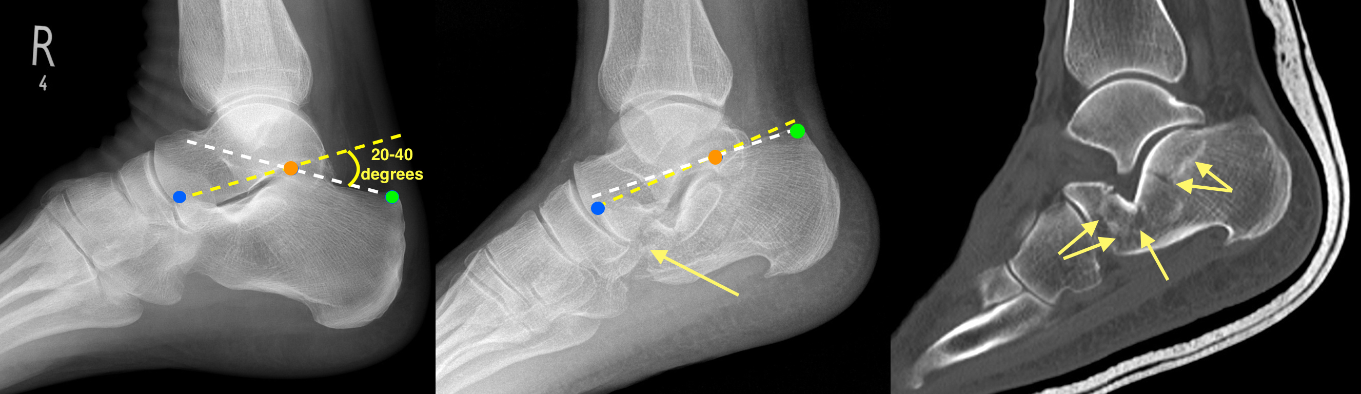 Calcaneal Fracture Radiology at St. Vincent's University Hospital