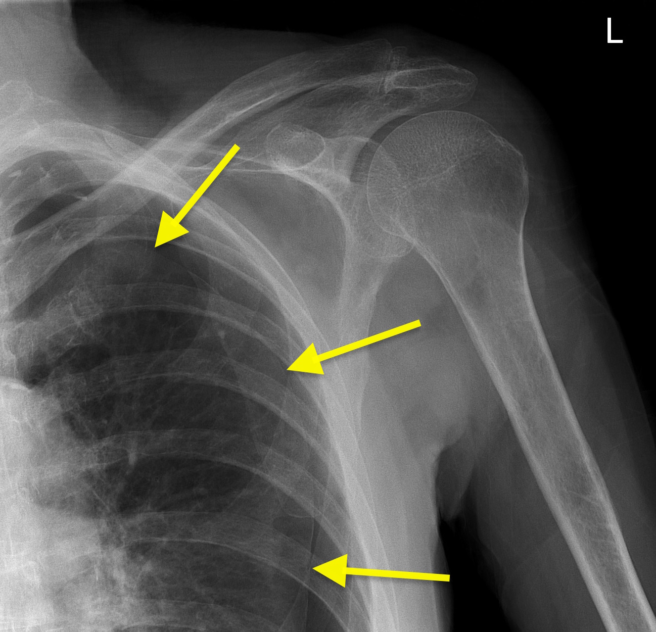 Pneumothorax on shoulder Xray Radiology at St. Vincent