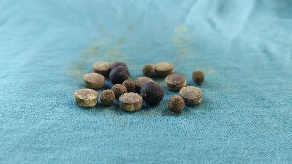 Finding The Best Ayurvedic Medicine For Gallbladder Stone