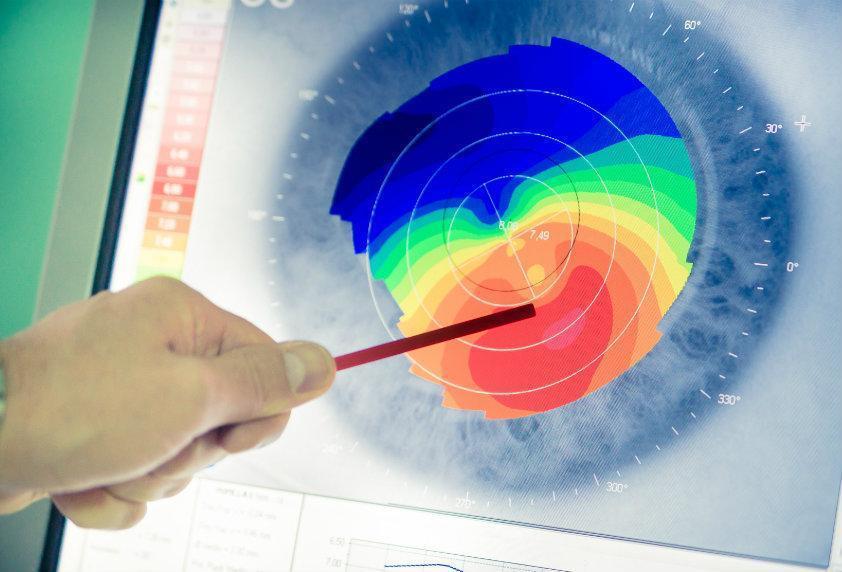 Keratoconus Causes, Treatments and Risks Southwestern Eye Center