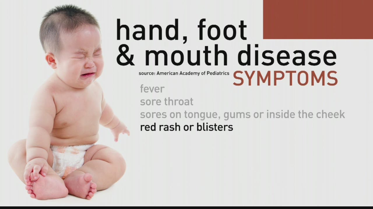 CPS Urges Parents and Guardians to be on alert to prevent Hand Foot and