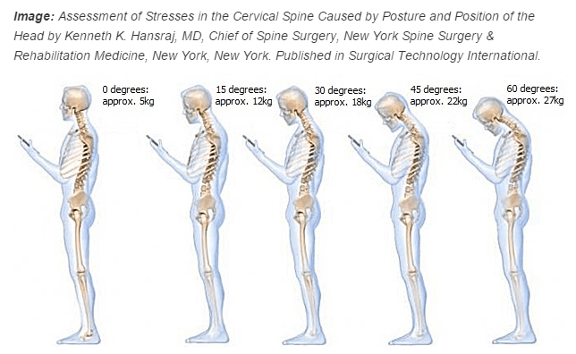 Do you suffer from "tech neck"? Ergoworks Physiotherapy