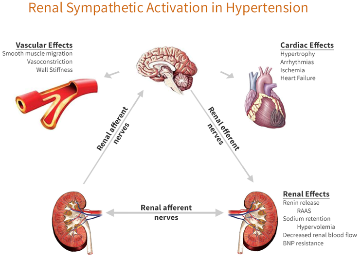 Renal Sympathetic Denervation Medical Microwave Ablation Technology