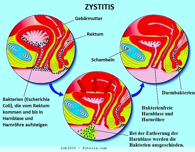 Schlechter Harngeruch, Ursachen, Symptome und Therapie