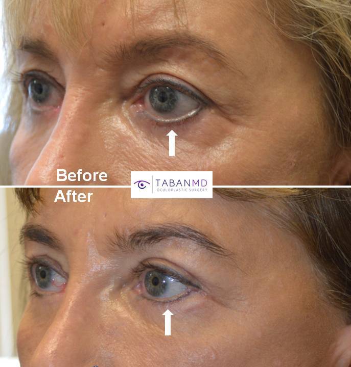 Eyelid Retraction Surgery Dr. Mehryar (Ray) Taban MD Oculoplastic