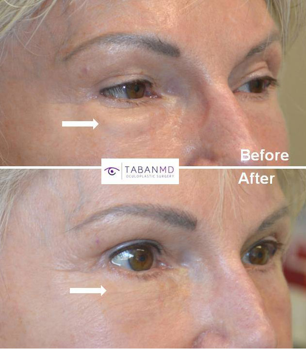 Revisional Eyelid Surgery Beverly Hills Taban MD