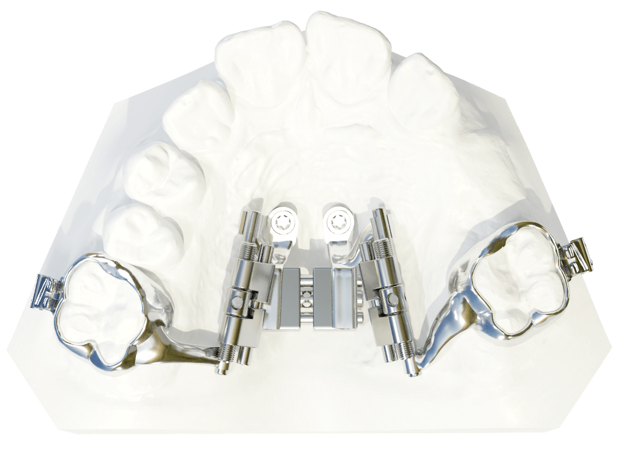 TADMAN Hybrid Hyrax Distalizer DIRECT TADMAN GmbH