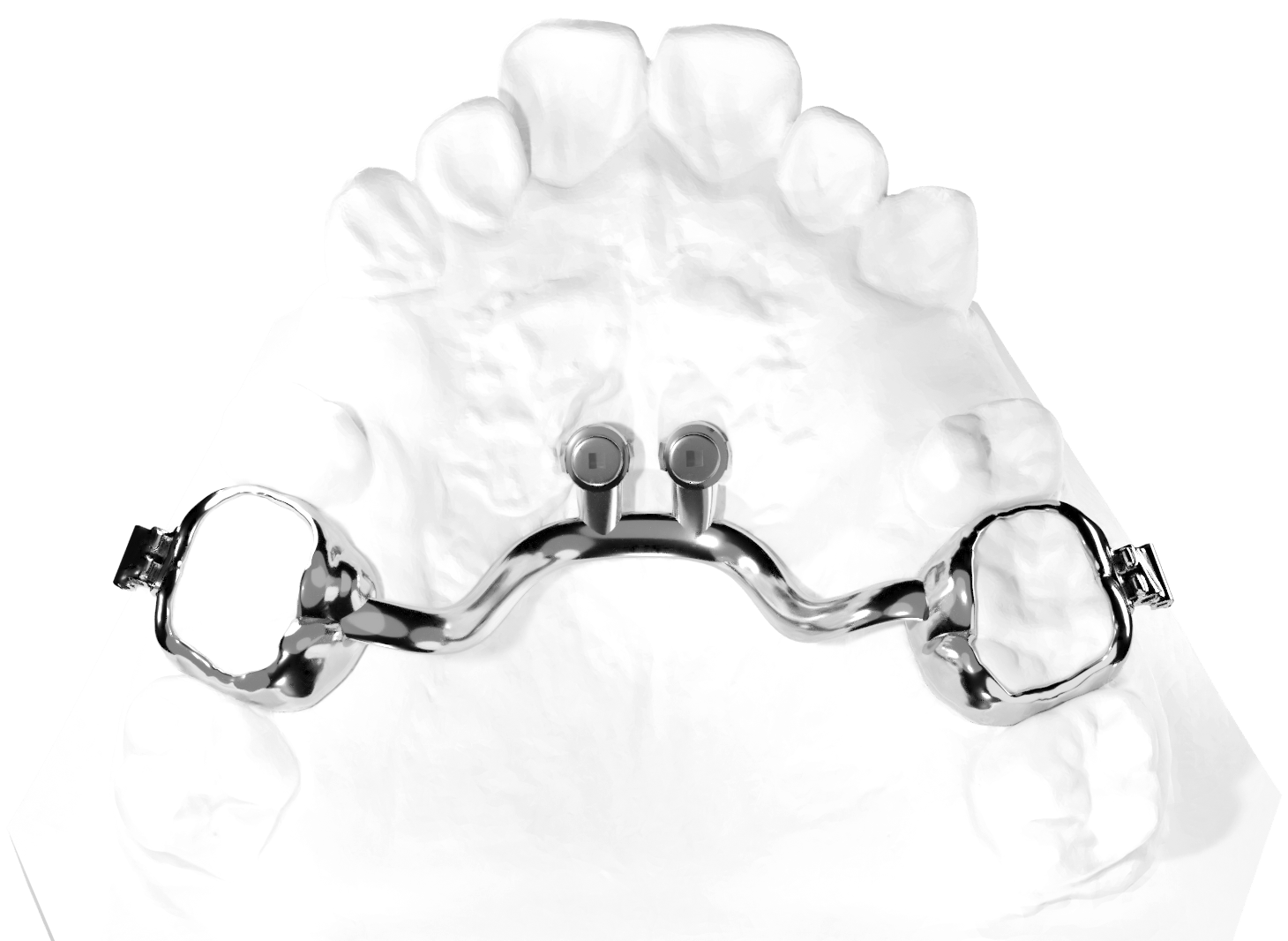 Transpalatal Arch Appliance