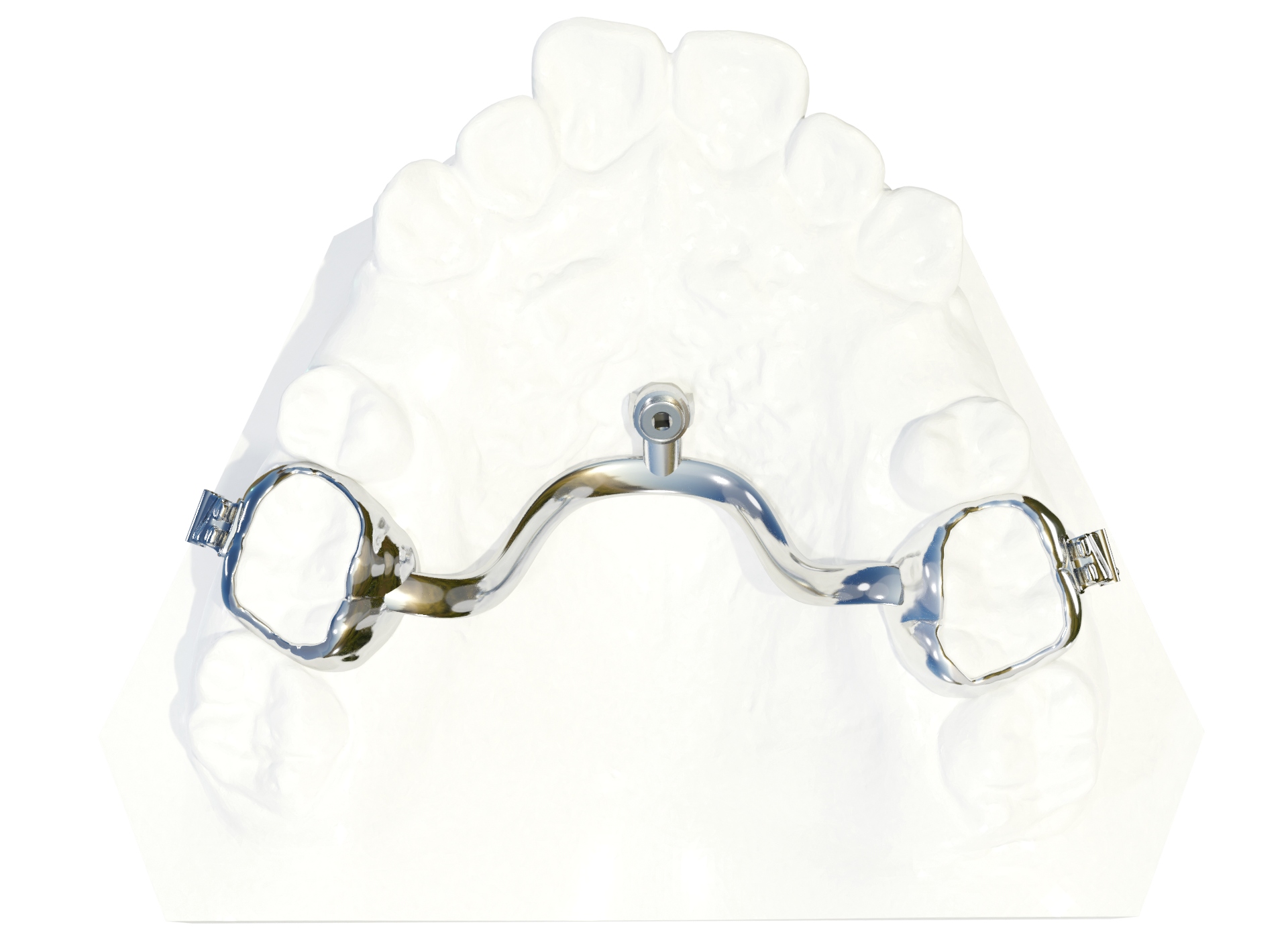 TADMAN TPA with Molar Shells for Median TAD TADMAN GmbH