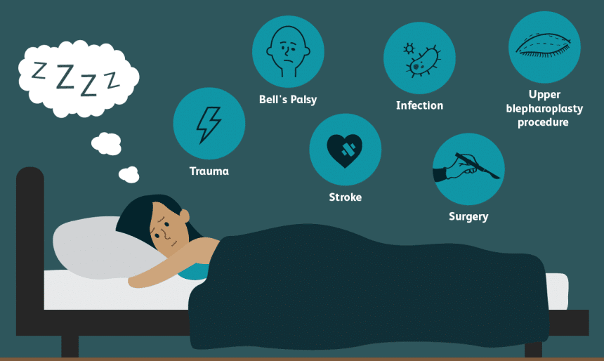 How to Sleep with Your Eyes Open Steps & Advice (Spring 2023)