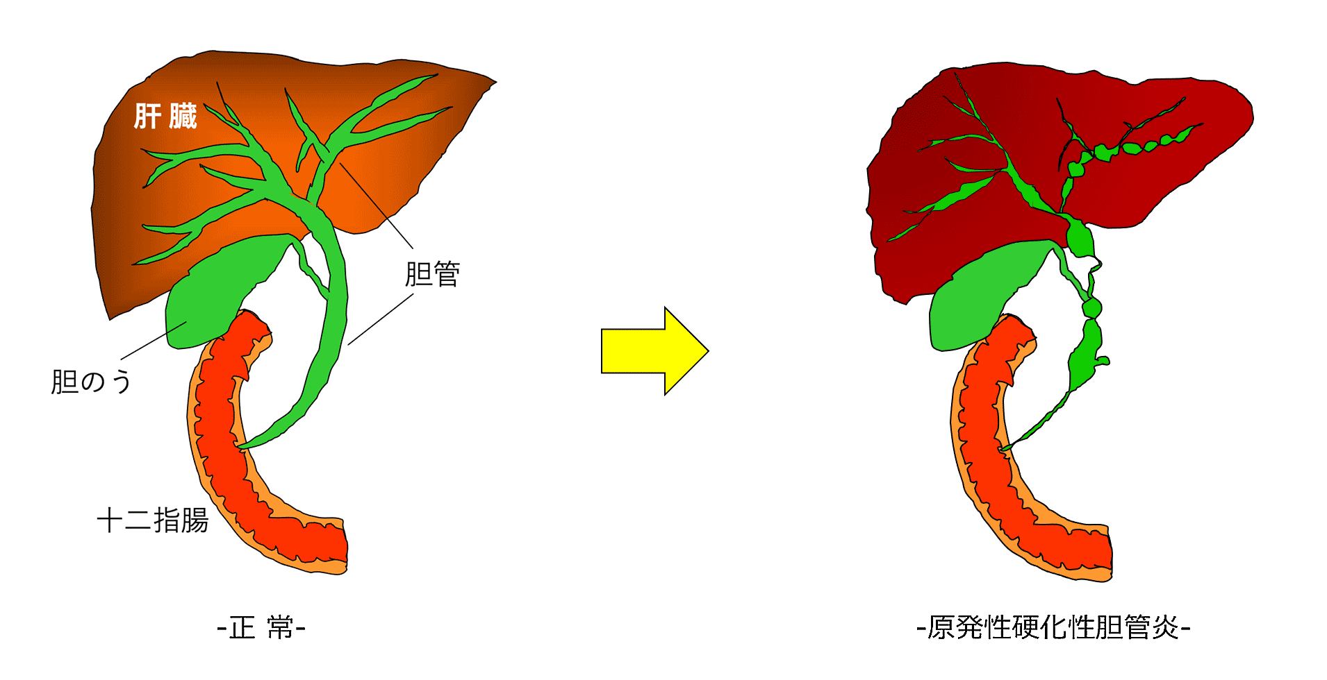 原発性硬化性胆管炎（PSC） 日本胆道学会