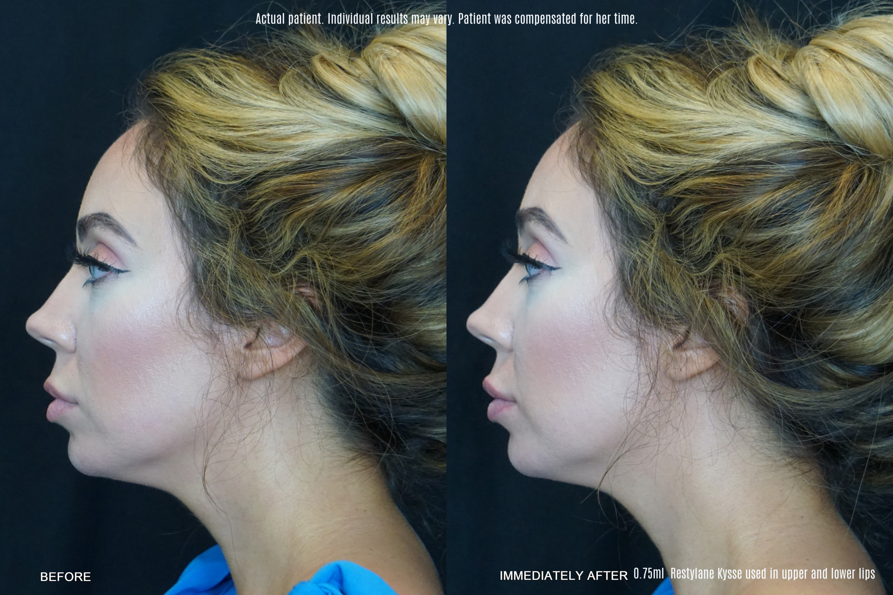 Restylane® Kysse The Most Kissable Lip Filler You Never Knew You