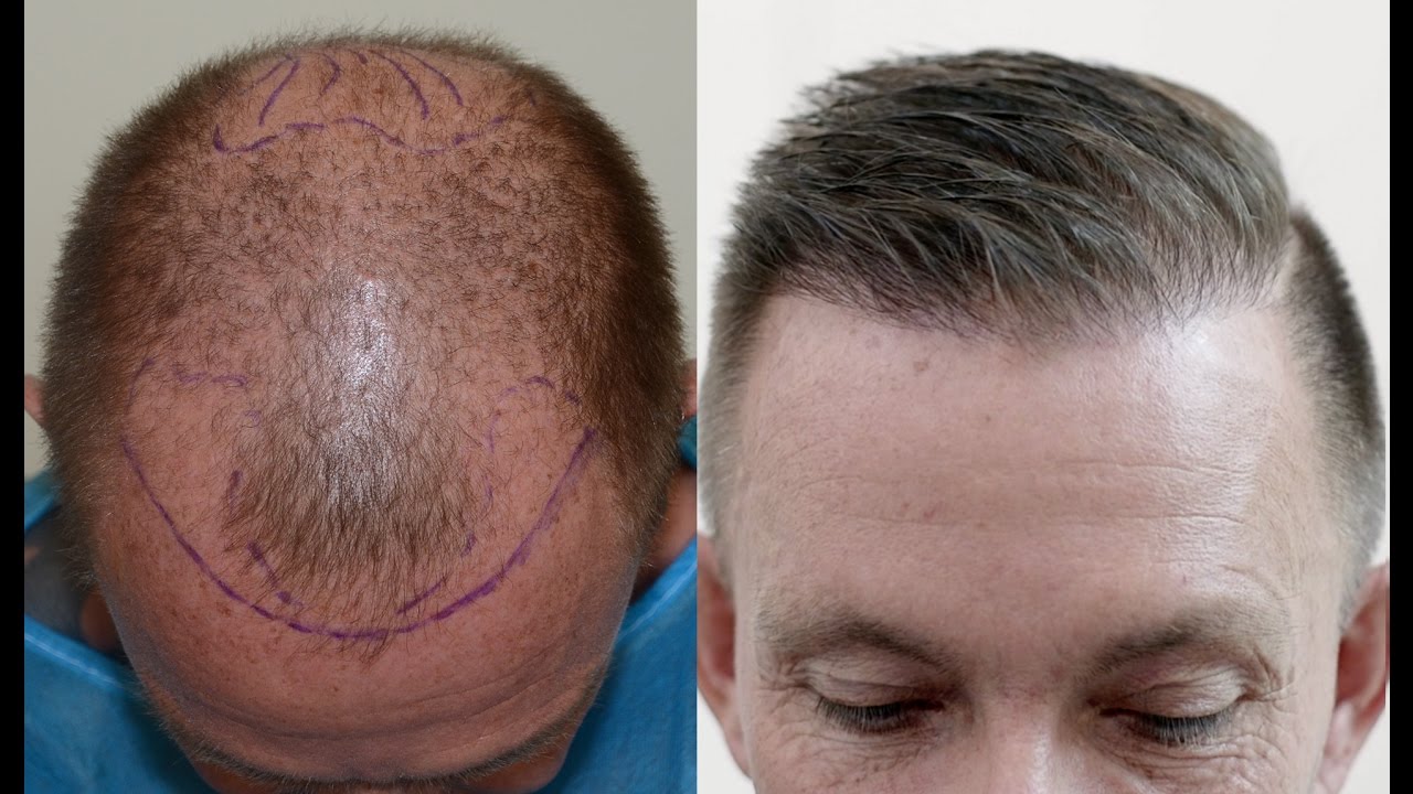 BUSTING MYTHS ABOUT HAIR TRANSPLANT