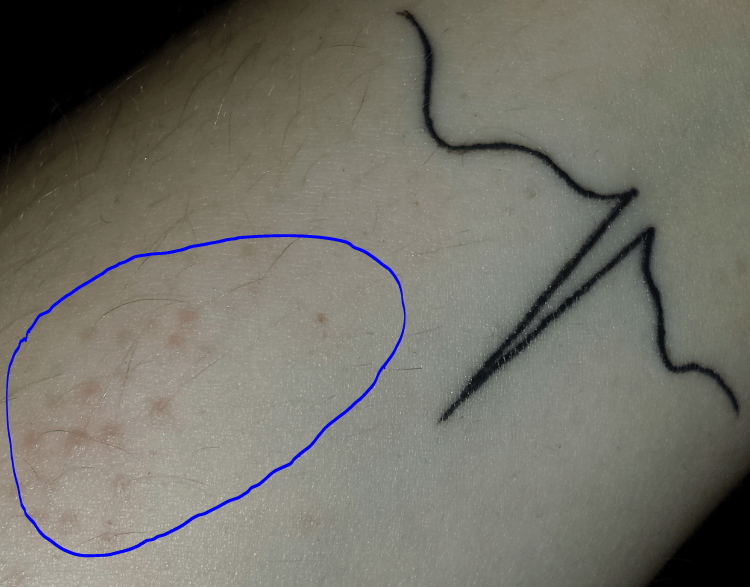 Allergische Reaktion auf Tattoo? TattooBewertung.de