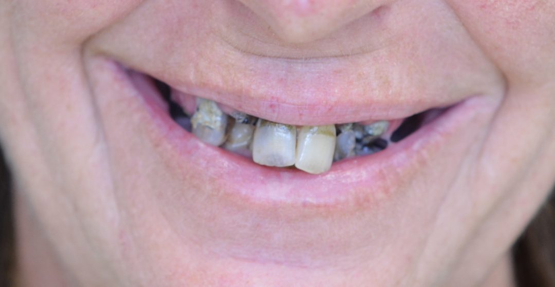 Before And After Dental Implants Gold Coast Taylor Dental Implants