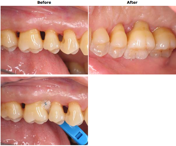 Examples of Before and After Berenguer Periodontics Periodontics and Oral Implantology