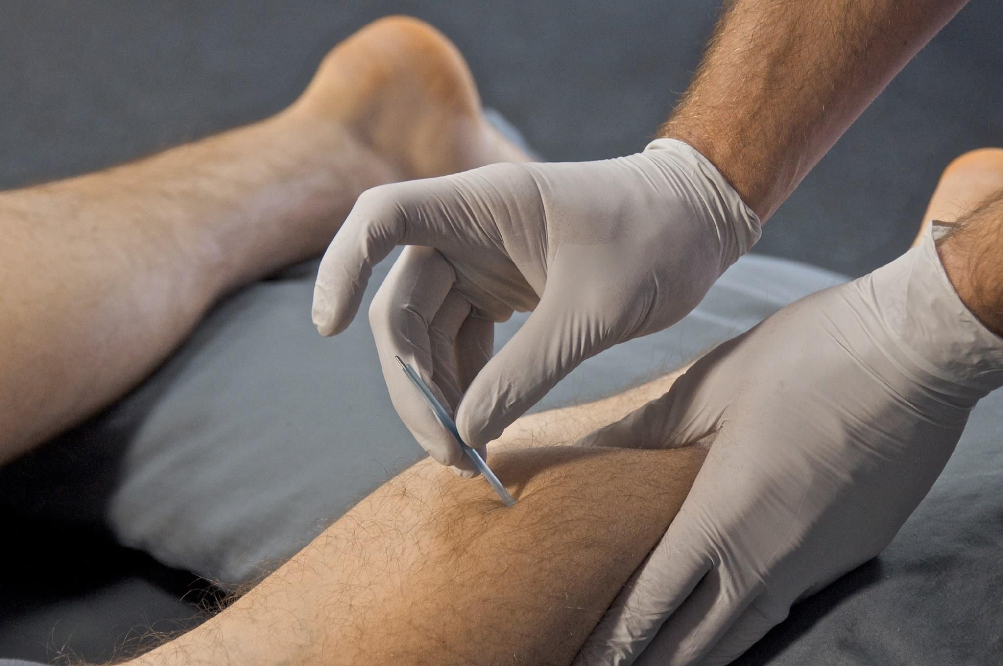 DRY NEEDLING Plantar fasciitis Plantar heel pain Tight Calves