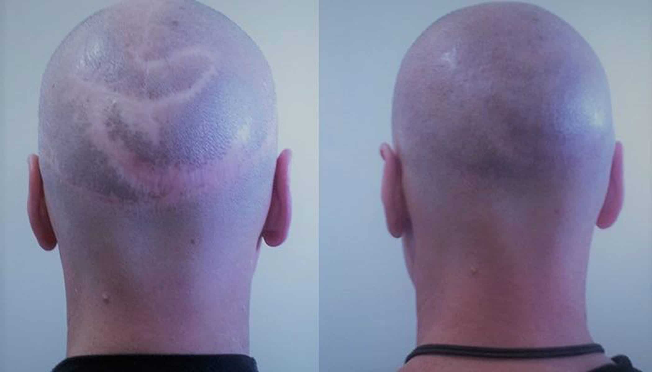 Hiding scalp reduction scars with scalp micropigmentation Hiding scalp reduction scars with scalp micropigmentation