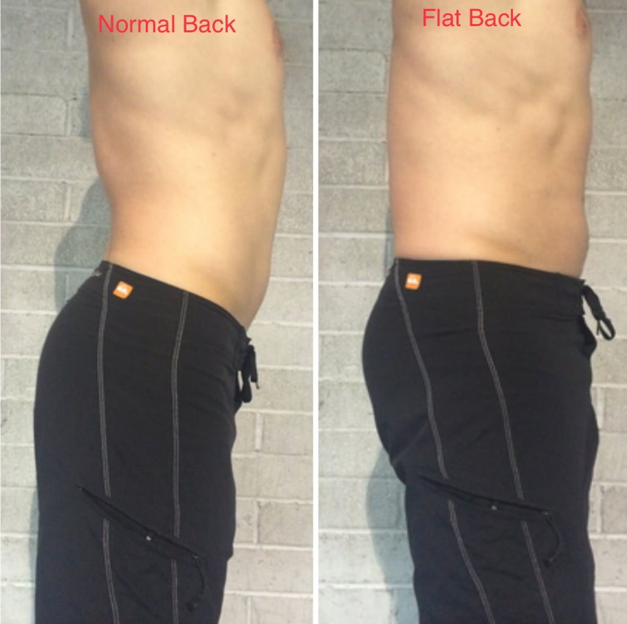 FLAT BACK HOW TO CORRECT ? TREATMENT, EXERCİSE