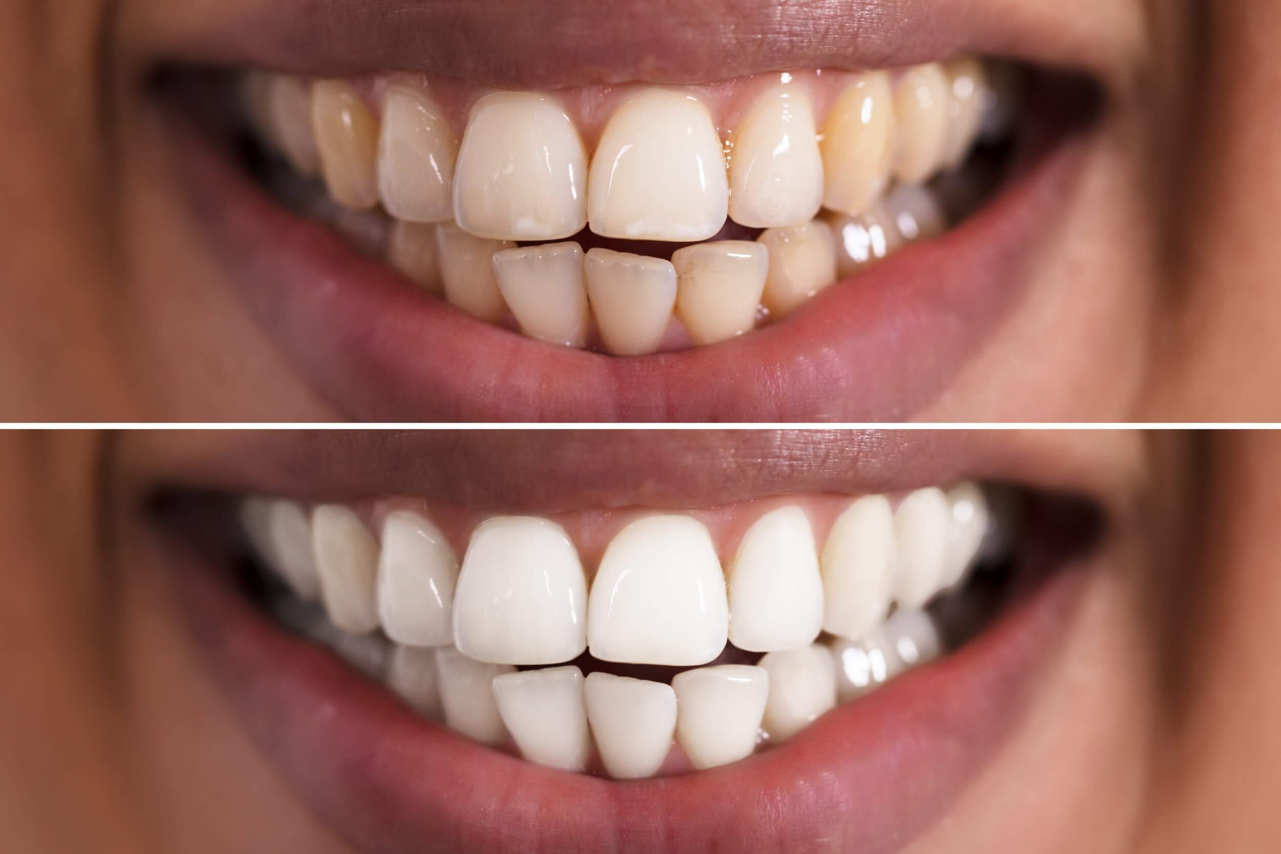 Teeth Whitening Birmingham Best Way To Whiten Teeth 10/10