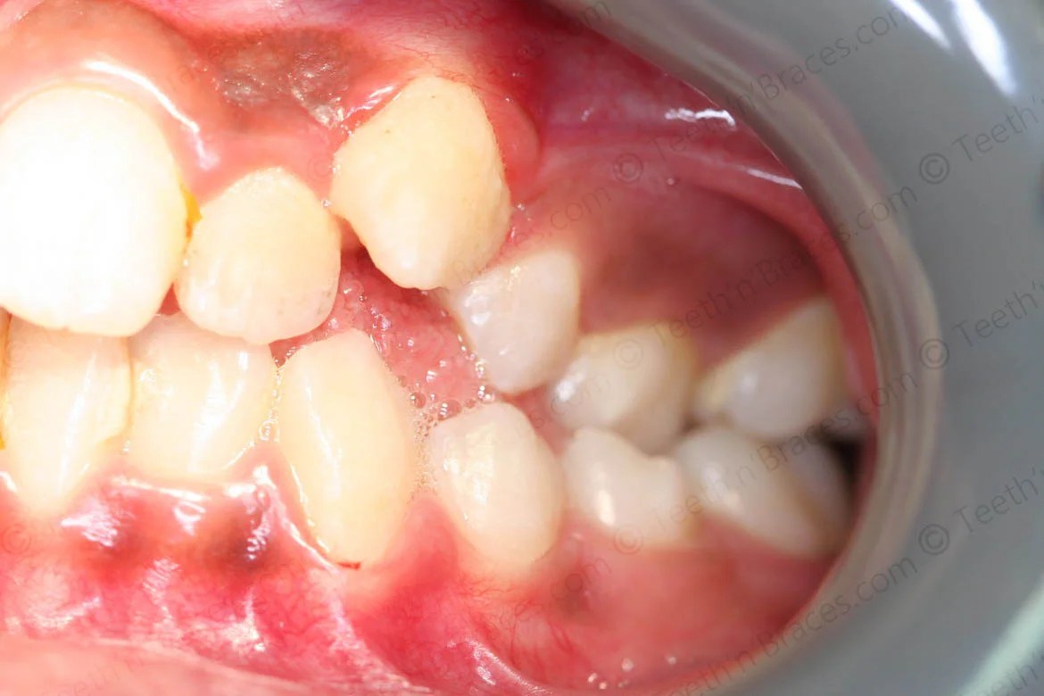 Case 19 Canines placed high and out Teeth N Braces